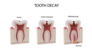 Tooth Decay Graphics | Root Canal Treatment