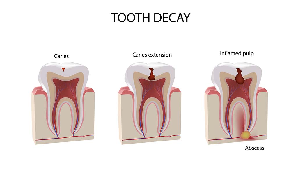 Root Canal Treatment And You