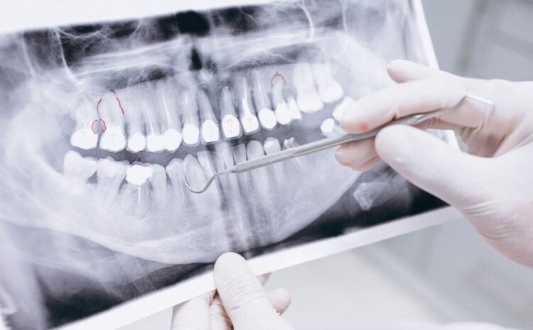 Dental X-Ray | Root Canal Treatment