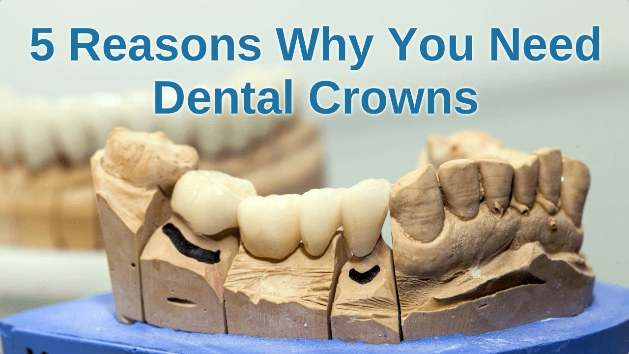 5 Reasons Why You Need Dental Crowns