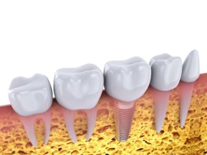 Best Dental Implant Services | Innovative Dental