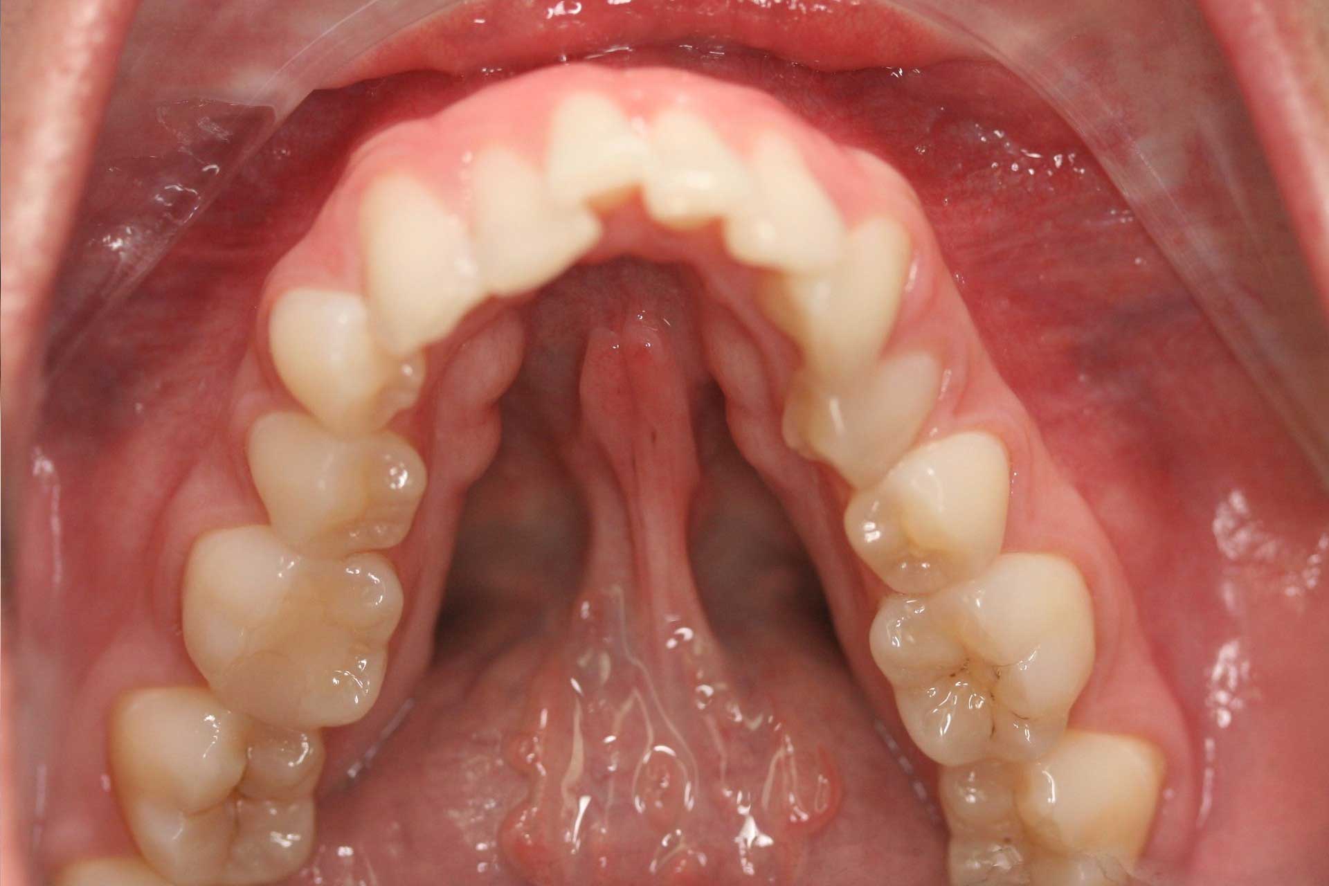 Teeth Condition Before Clear Aligner Treatment