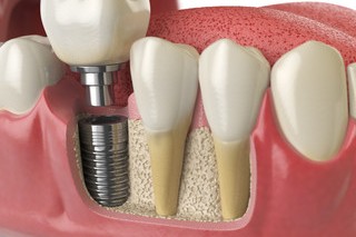 Dental Implants for missing teeth