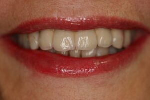 woman's teeth | dental implant treatment for multiple teeth | Innovative Dental