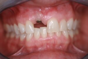 Single Tooth Implant | Innovative Dental
