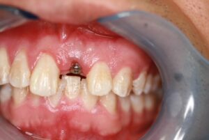 Single Tooth Implant | Innovative Dental