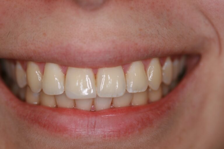 Teeth whitening at Moonee Ponds | Innovative Dental