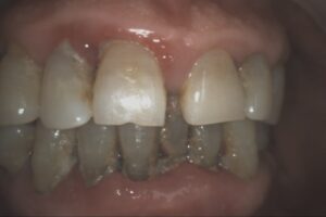 Whole Mouth Plant | Innovative Dental