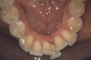 Crooked Teeth for Dental Alignment Treatment | Orthodontics | Innovative Dental