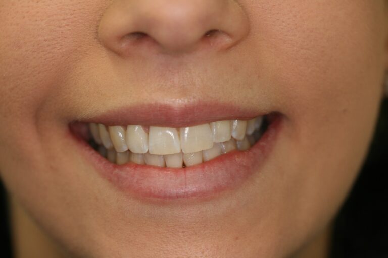 Whitening Teeth | Innovative Dental