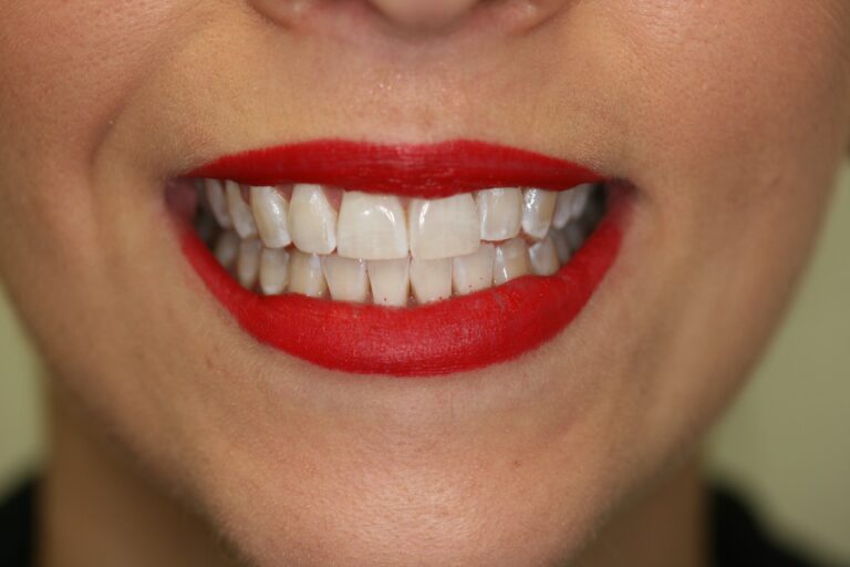 Case 5 for Teeth Whitening Treatment