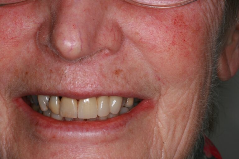 Yellowish Teeth Before Whitening Treatment | Smile Gallery