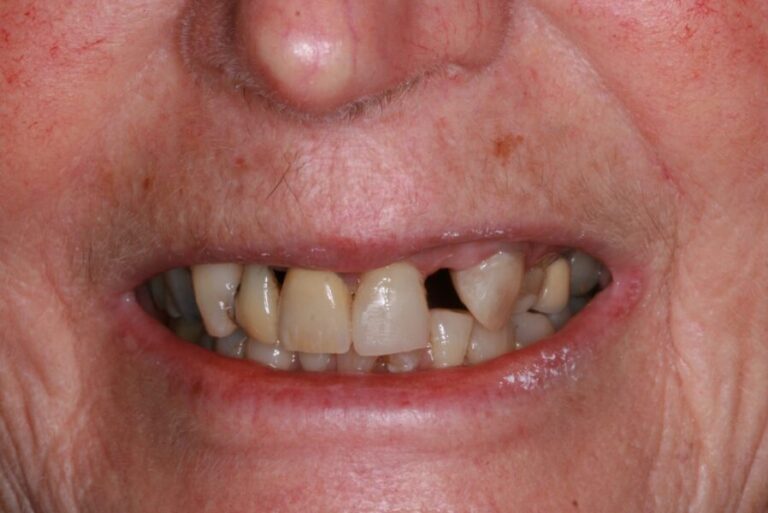 Smile Gallery Before Dental Treatment | Innovative Dental