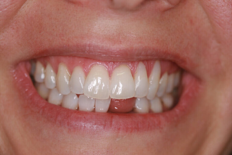 Missing Teeth | Before Dental Treatment | Innovative Dental