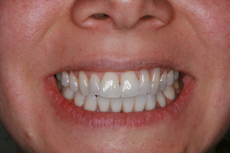 Crown Veneer Treatment | Innovative Dental