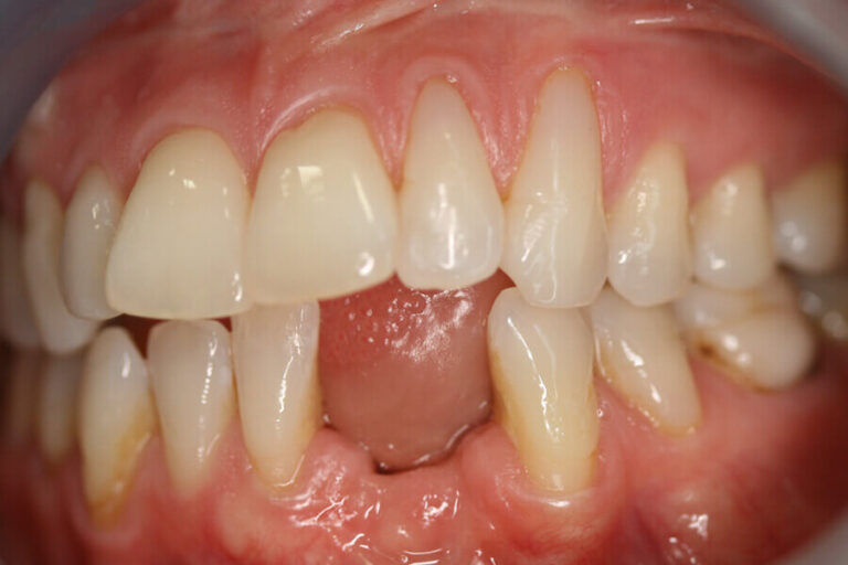 Missing Teeth | Dental Implant Solution