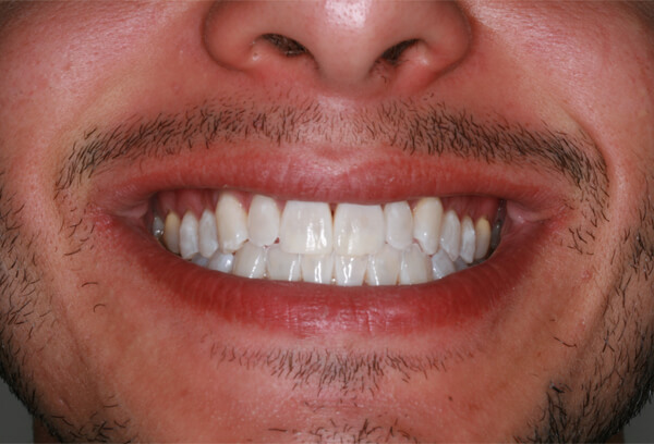 After Teeth Whitening Treatment | Innovative Dental