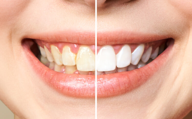  What Can I Do About My Discoloured Teeth?