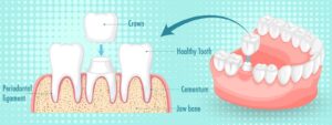 Root Canal Treatment | Innovative Dental