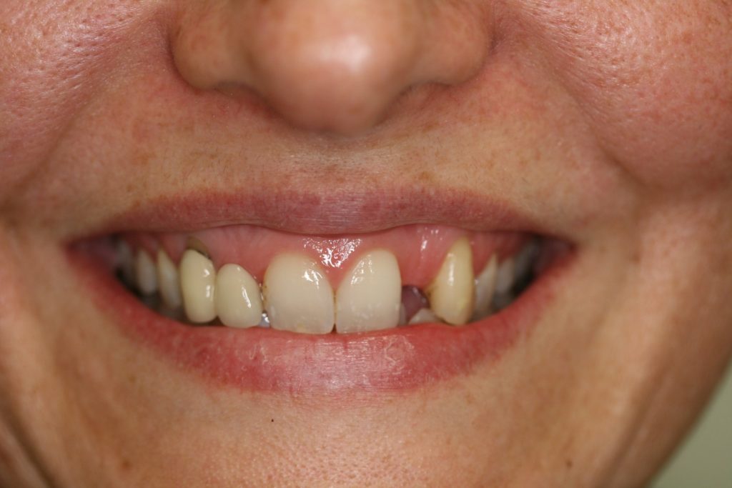 Missing Tooth Concern | Dental Implant Solution