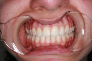 Moone Ponds Victoria Clear Aligners - After