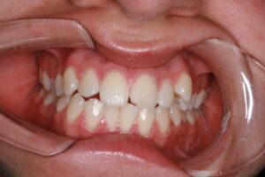 Clear Aligner Treatment | Innovative Dental Moonee Ponds Victoria