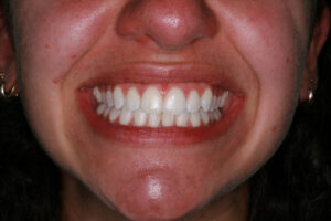 Clear Aligners in Moone Ponds Victoria - After