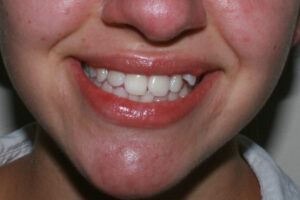 Clear Aligners in Moone Ponds | Before Treatment