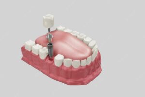 Dental Implant Procedure Simulation | Dental Implants at Innovative Dental