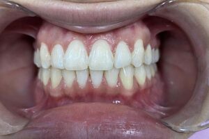 Clear Aligners Services Innovative Dental