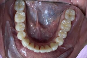 After Clear Aligner Treatment | Innovative Dental