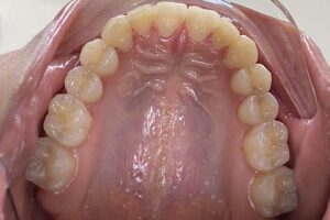 Clear aligners for teeth Innovative Dental
