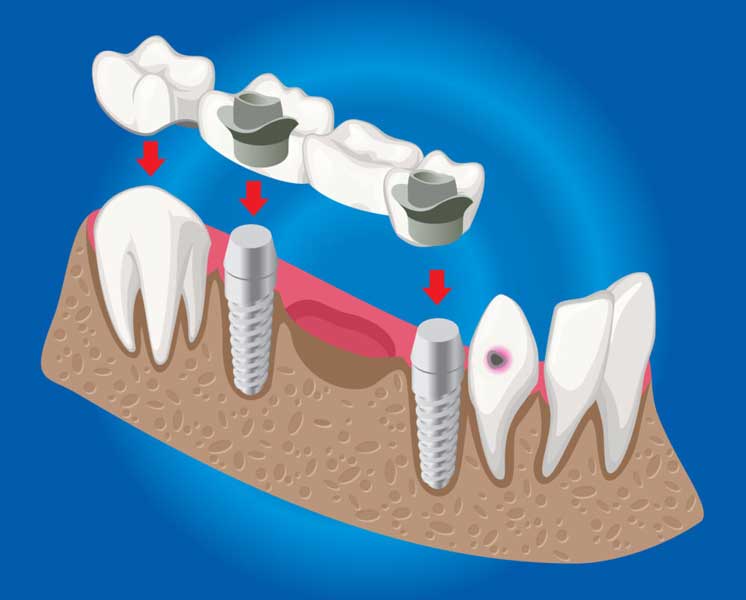 Dental Implants, Bridges, and Dentures