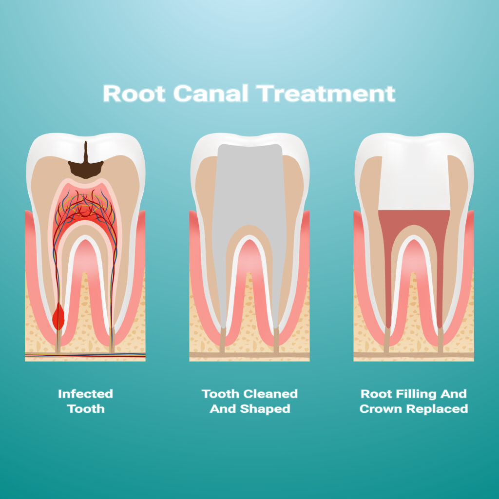 a-complete-guide-to-root-canal-and-its-treatment