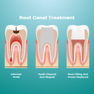 All about Root Canal and Its Treatment