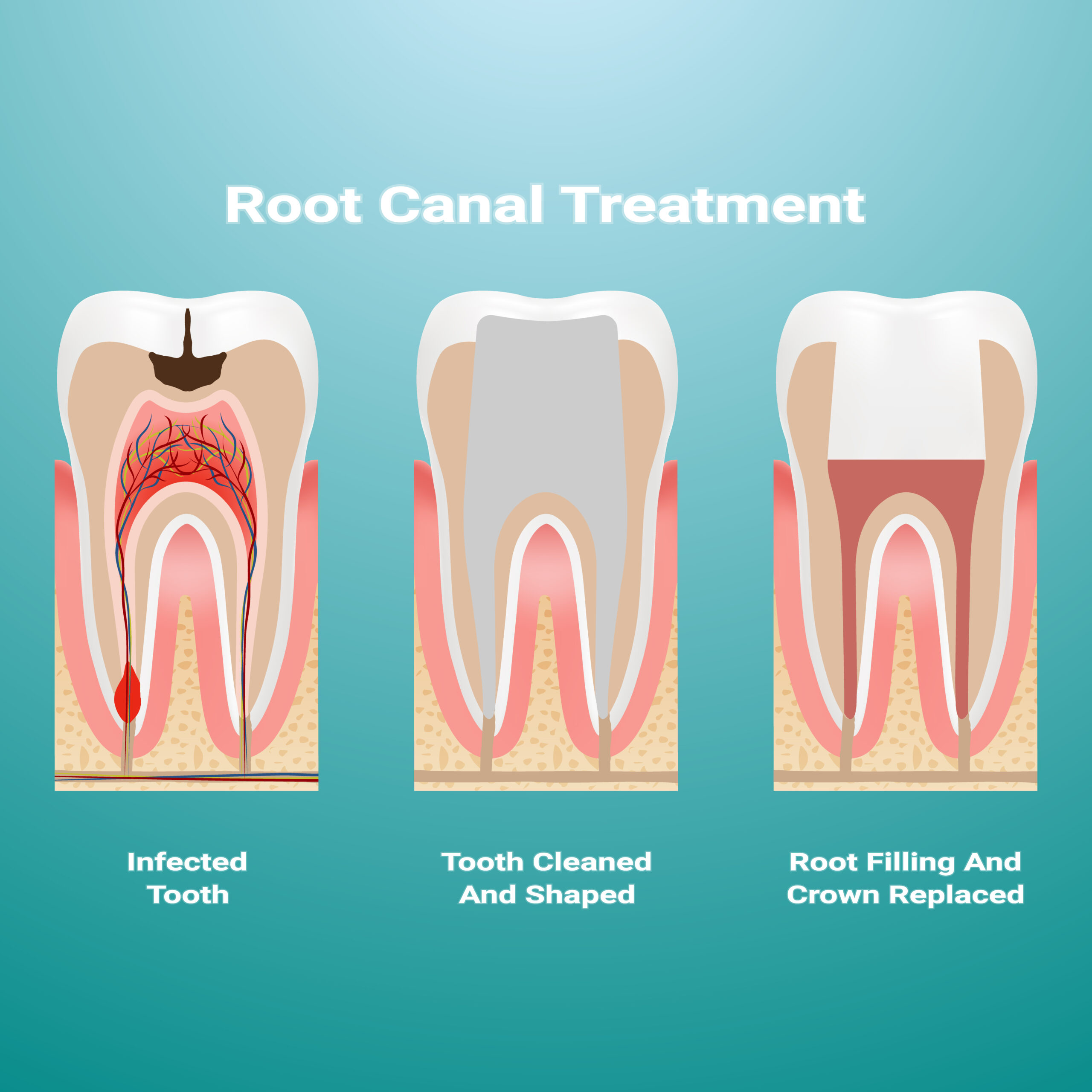 A Complete Guide to Root Canal and Its Treatment