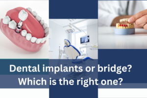 Dental implants or bridge