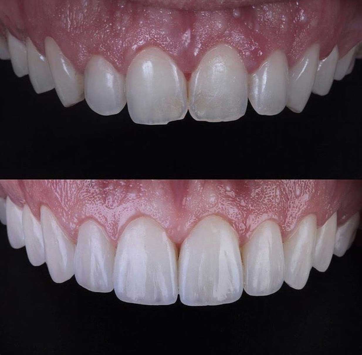 Porcelain Veneers Vs Dental Bonding: Choosing the Perfect Smile Enhancement
