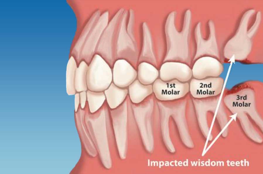 What Do You Expect When Getting Your Wisdom Teeth Removed